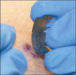 Aireys Inlet Skin Cancer Clinic - A Shave Biopsy